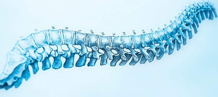 Scoliosis Spine