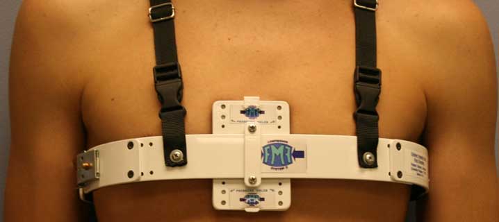 Pectus carinatum brace