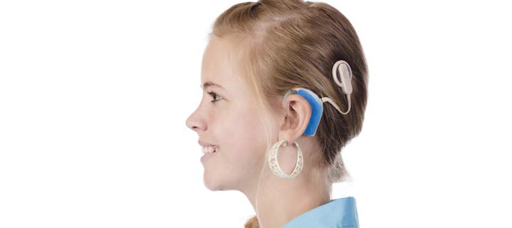 Cochlear Implant