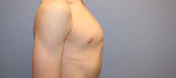 Pectus Carinatum