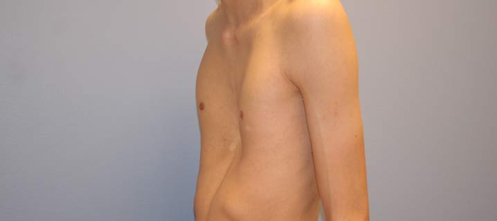 Pectus Excavatum Explanation